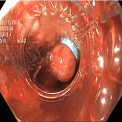 лигирование ВРВП